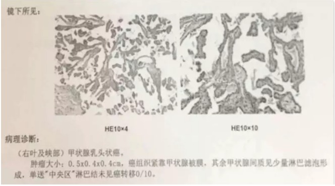 別慌，甲狀腺疾病還可以這樣投保！