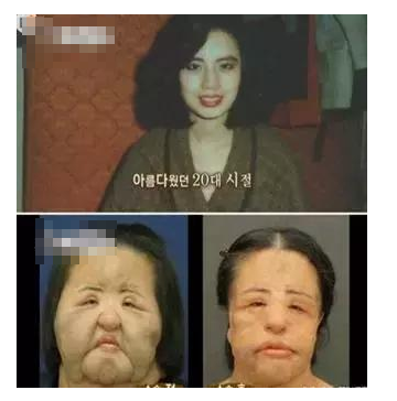 整容發(fā)生意外保險賠嗎？